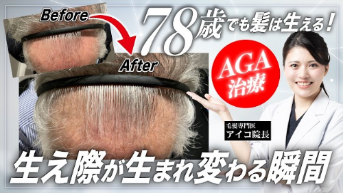 症例1：長期AGA治療の実績