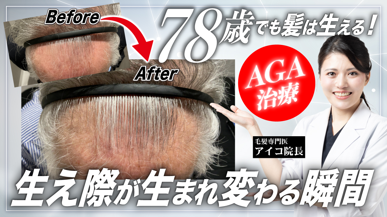 【症例紹介】78歳男性 年齢であきらめない薄毛治療の可能性【AGA】
