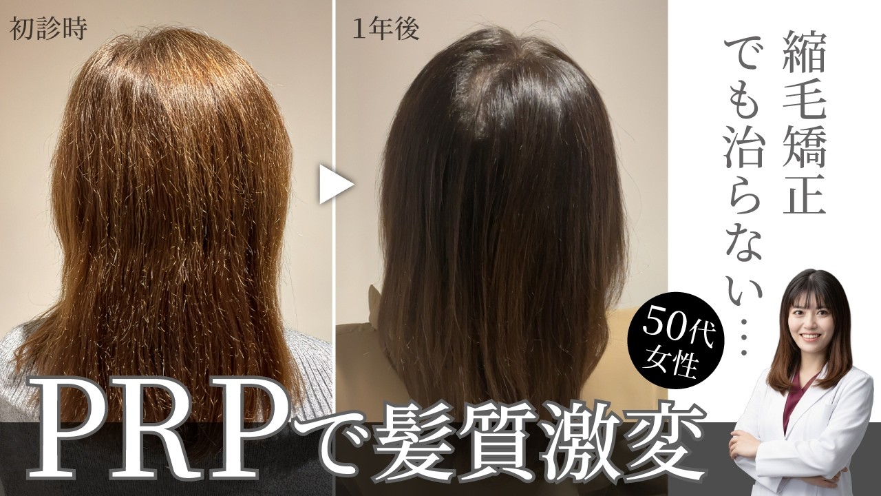 【50代女性】縮毛矯正でも治らない髪質がPRP療法で激変
