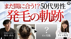 50代で治療を決意！AGA治療症例のリアルをご紹介！