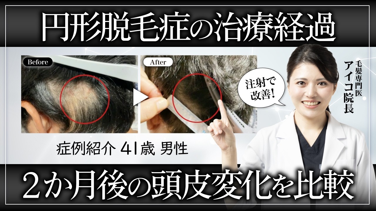 円形脱毛症の最新治療法｜ケナコルト注射とエクソソーム療法で2ヶ月で劇的改善した症例