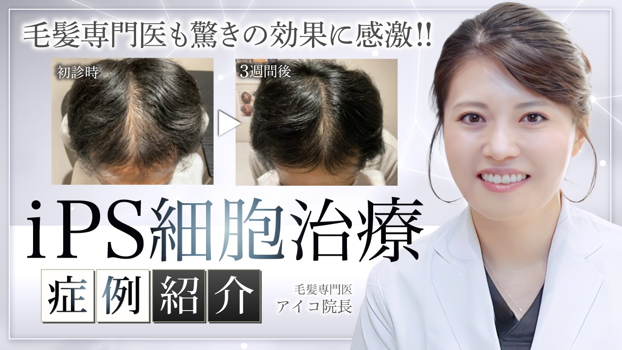 【症例実績公開】iPS細胞によるAGA治療の驚異的な効果とは？わずか3週間で実感できた薄毛改善の実例