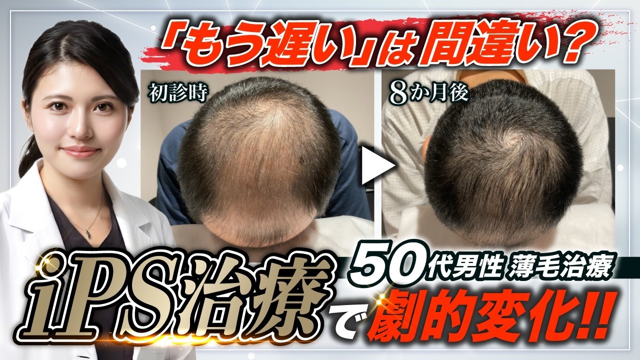 【50代男性の薄毛治療】「もう遅い」は間違い？iPS治療を組み合わせた8ヶ月の治療経過を解説