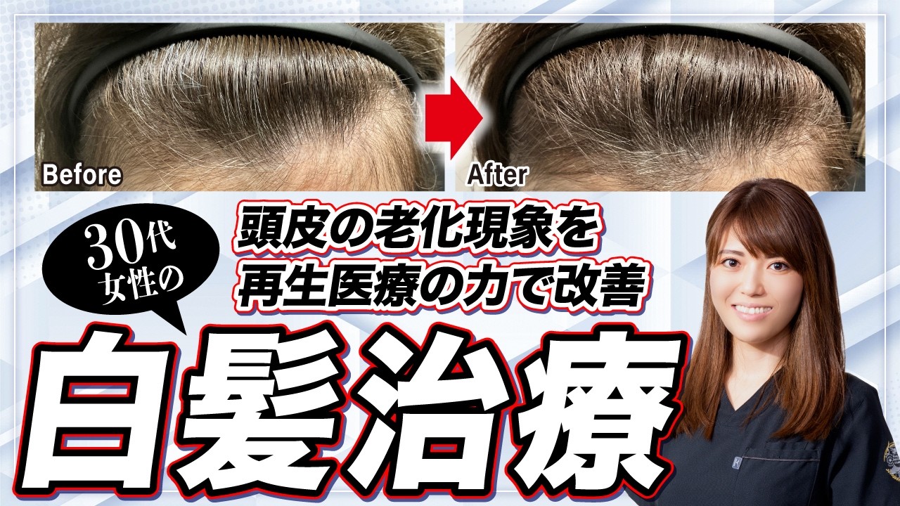 【症例紹介】30代女性の白髪悩みを再生医療の力で改善【白髪】【再生医療】