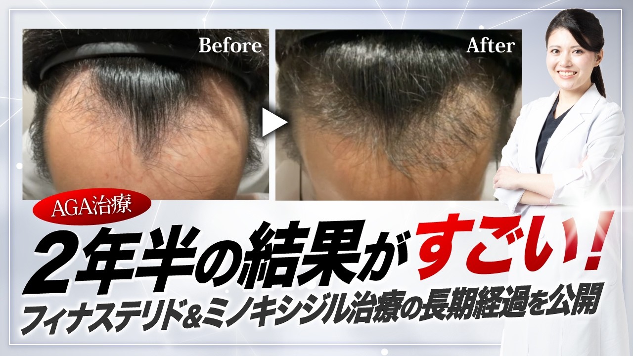 【AGA治療】2年半の結果がすごい！フィナステリド＆ミノキシジル治療の長期経過を公開