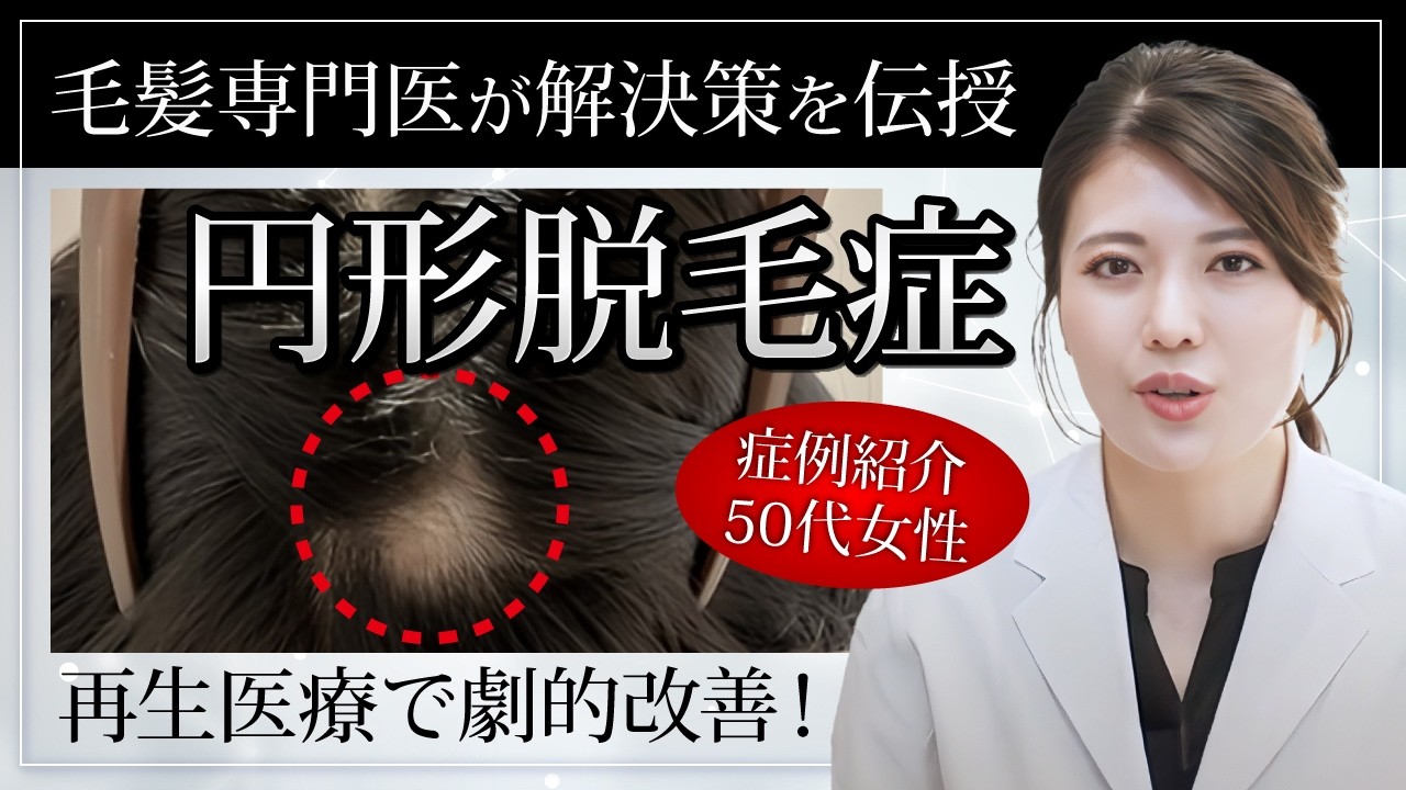 10年悩んだ円形脱毛症が再生医療で改善した_50代女性症例紹介【薄毛】【円形脱毛症】
