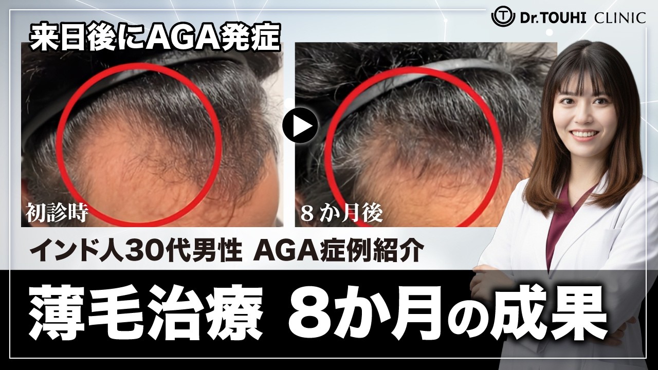 【外国人AGA症例】来日後に急速進行？8ヶ月でここまで改善した治療法とは