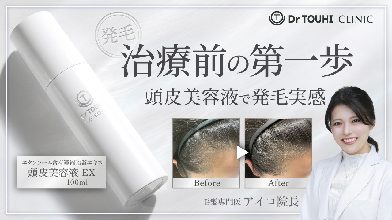 【治療前に試したい】頭皮美容液だけで髪の密度に変化【抜け毛】【薄毛】【エクソソーム】