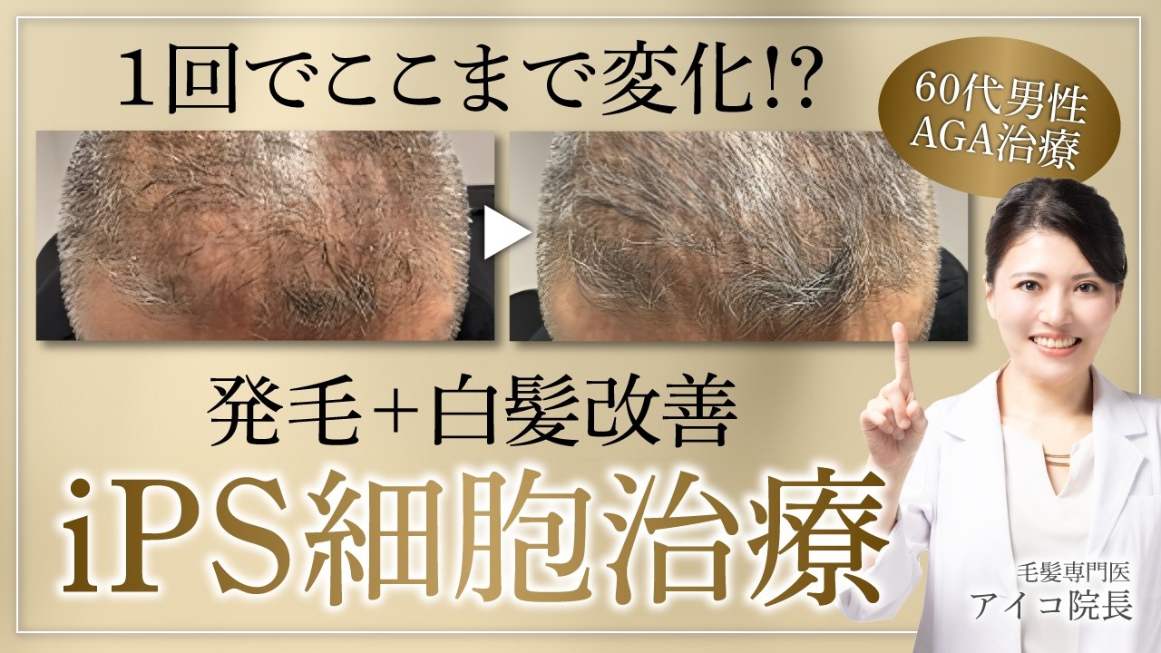 1回の治療で発毛＆白髪改善！iPS細胞培養上清液治療がすごい_60代男性のAGA症例紹介【再生医療】