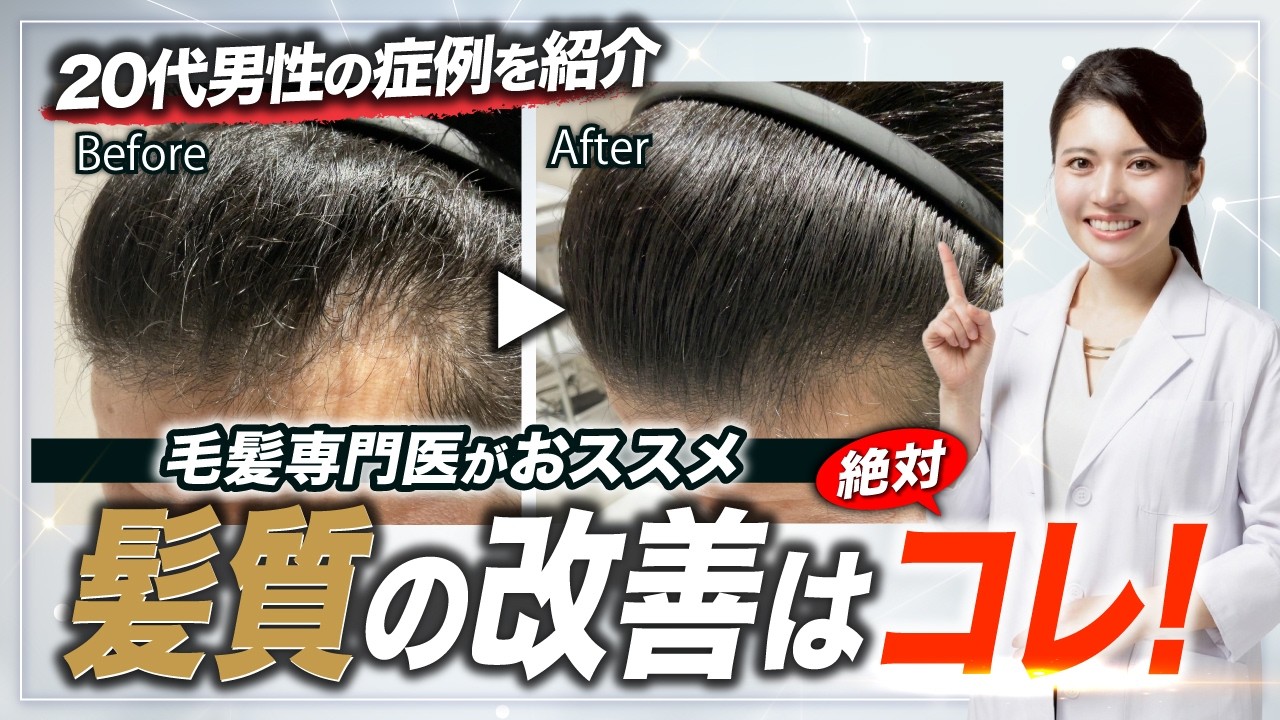 【毛髪専門医が解説】くせ毛は頭皮と関係する？20代男性の症例から髪質の変化を解説